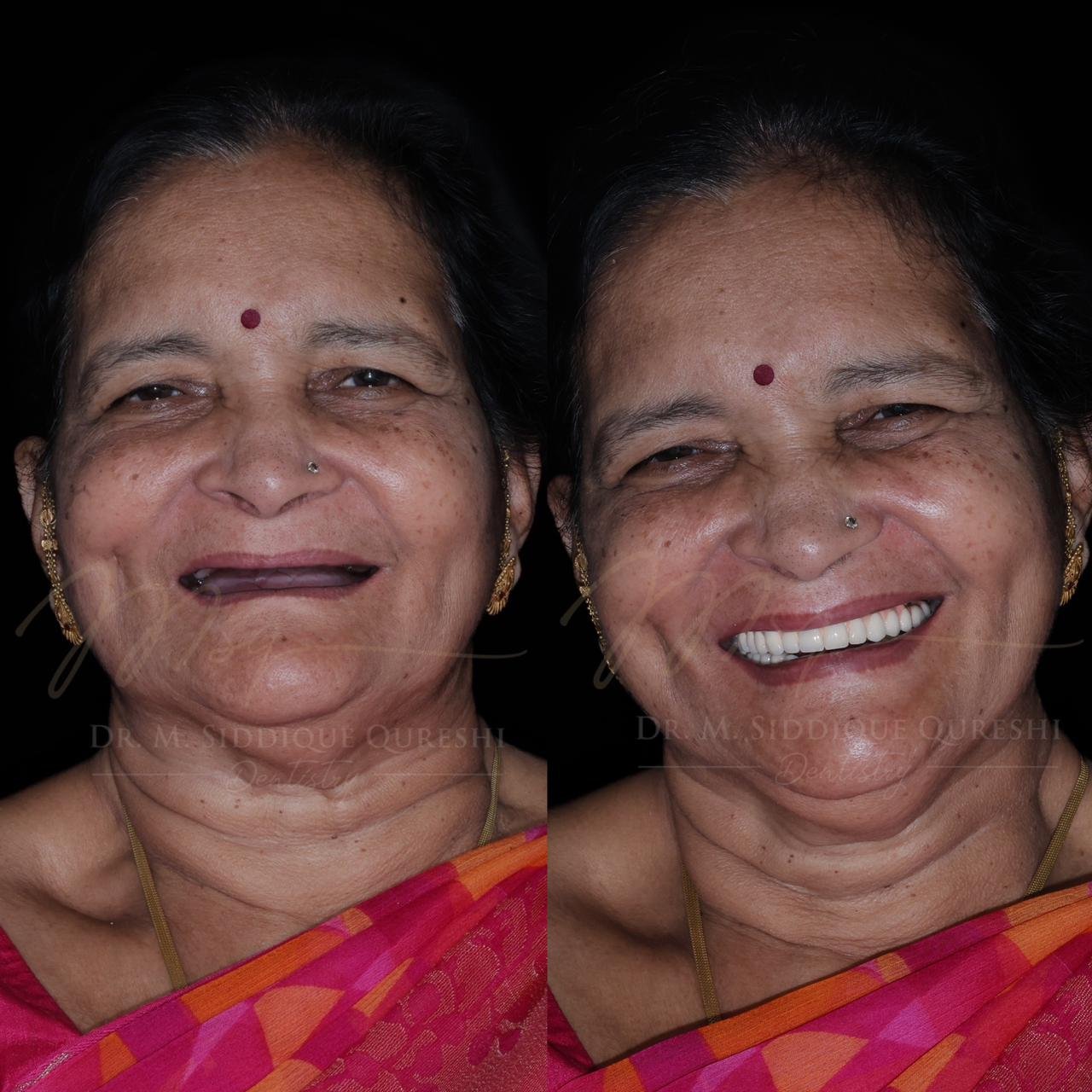 Before and after full mouth dental implant treatment showing smile transformation by Dentist in Indore