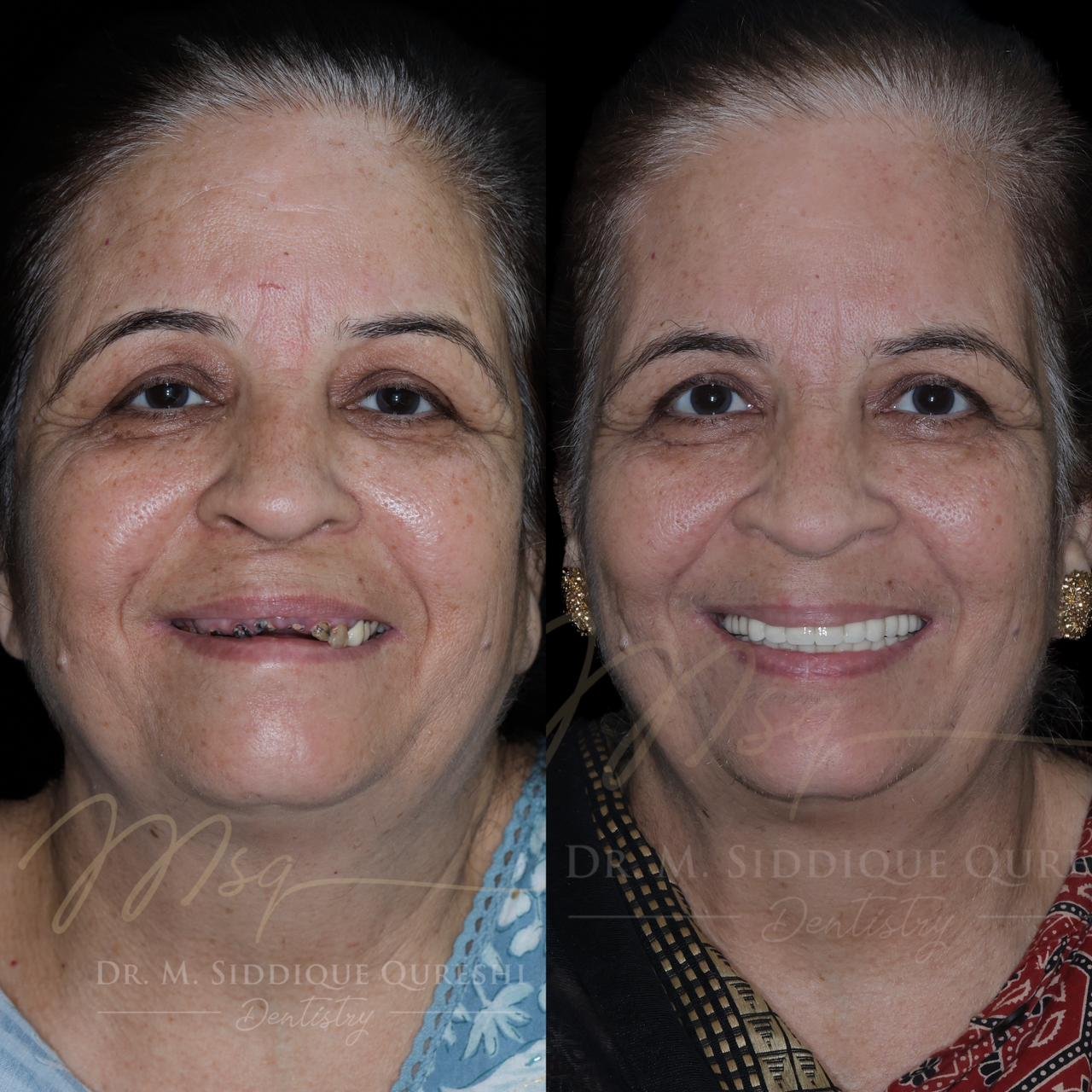 Before and after full mouth dental implant treatment showing complete smile restoration in Indore