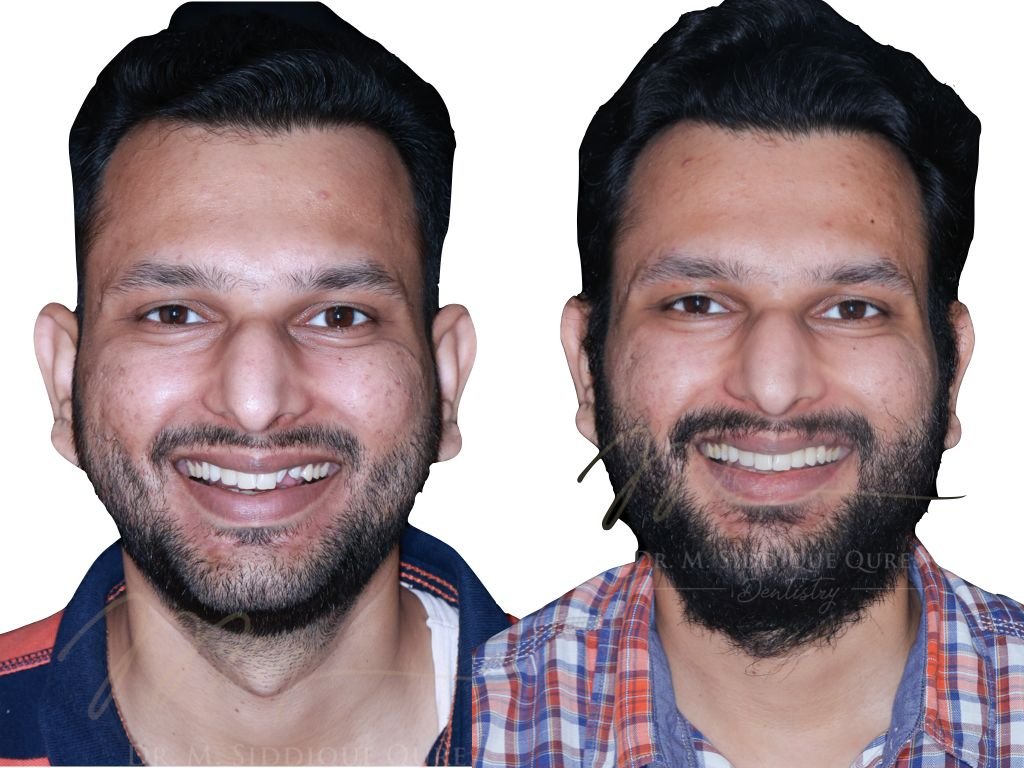 Before and after dental smile makeover showing teeth alignment and smile improvement in Indore