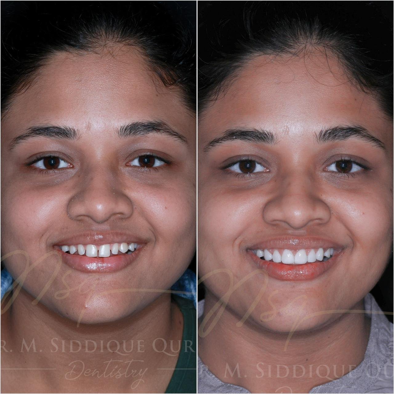 Before and after smile design treatment showing teeth alignment and cosmetic dental improvement by Dentist in Indore