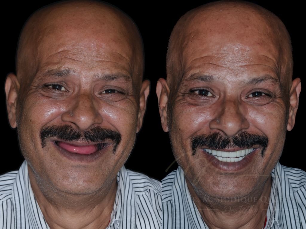 Before and after full mouth dental implant treatment showing smile transformation by Dentist in Indore