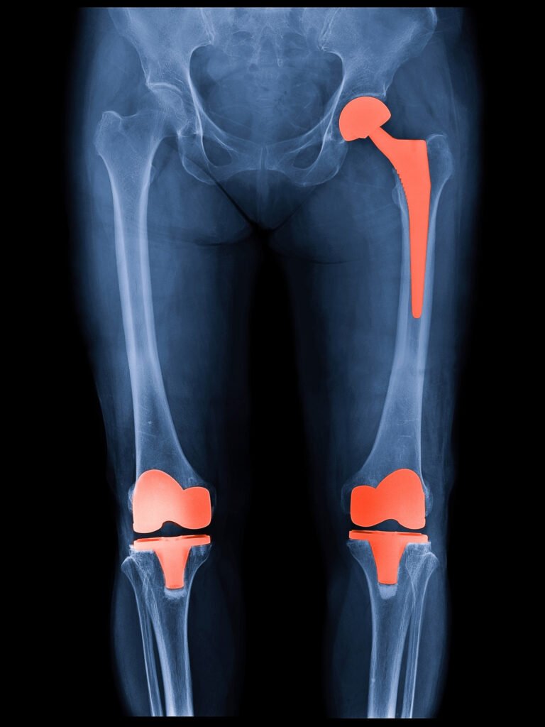 X-ray showing hip and knee joint replacement implants after joint replacement surgery