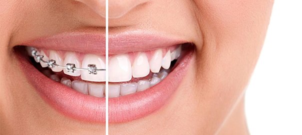 Braces and clear aligners treatment for teeth straightening in Indore