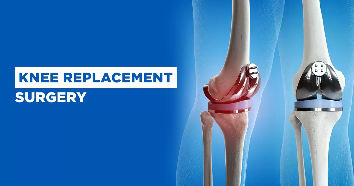 Knee replacement surgery illustration showing artificial knee joint implant for arthritis treatment