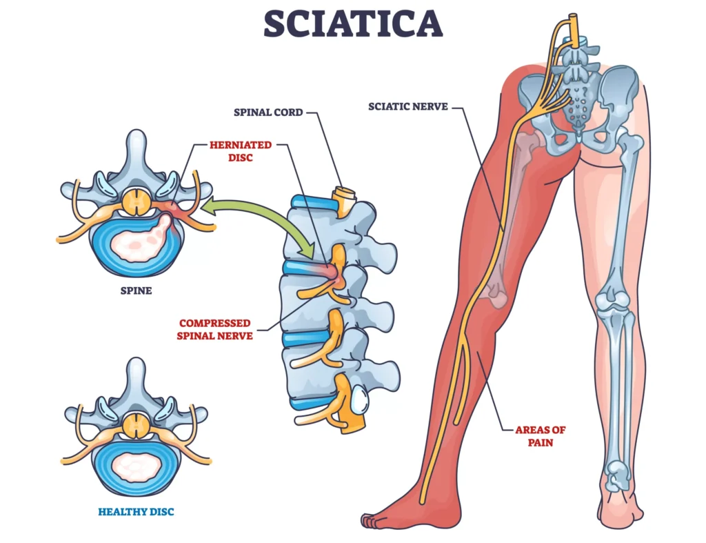 Sciatica nerve diagram showing herniated disc compressing spinal nerve and causing leg pain