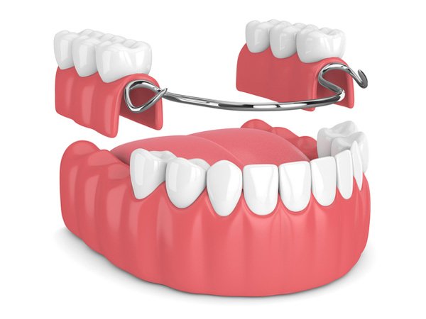 Removable partial denture with metal clasp for missing teeth replacement in Indore