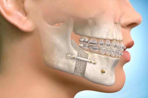 Jaw correction surgery with braces and fixation plates for proper jaw alignment and bite correction