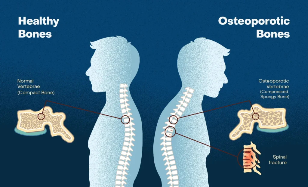 Comparison of healthy bones and osteoporotic bones showing spine compression and bone weakness