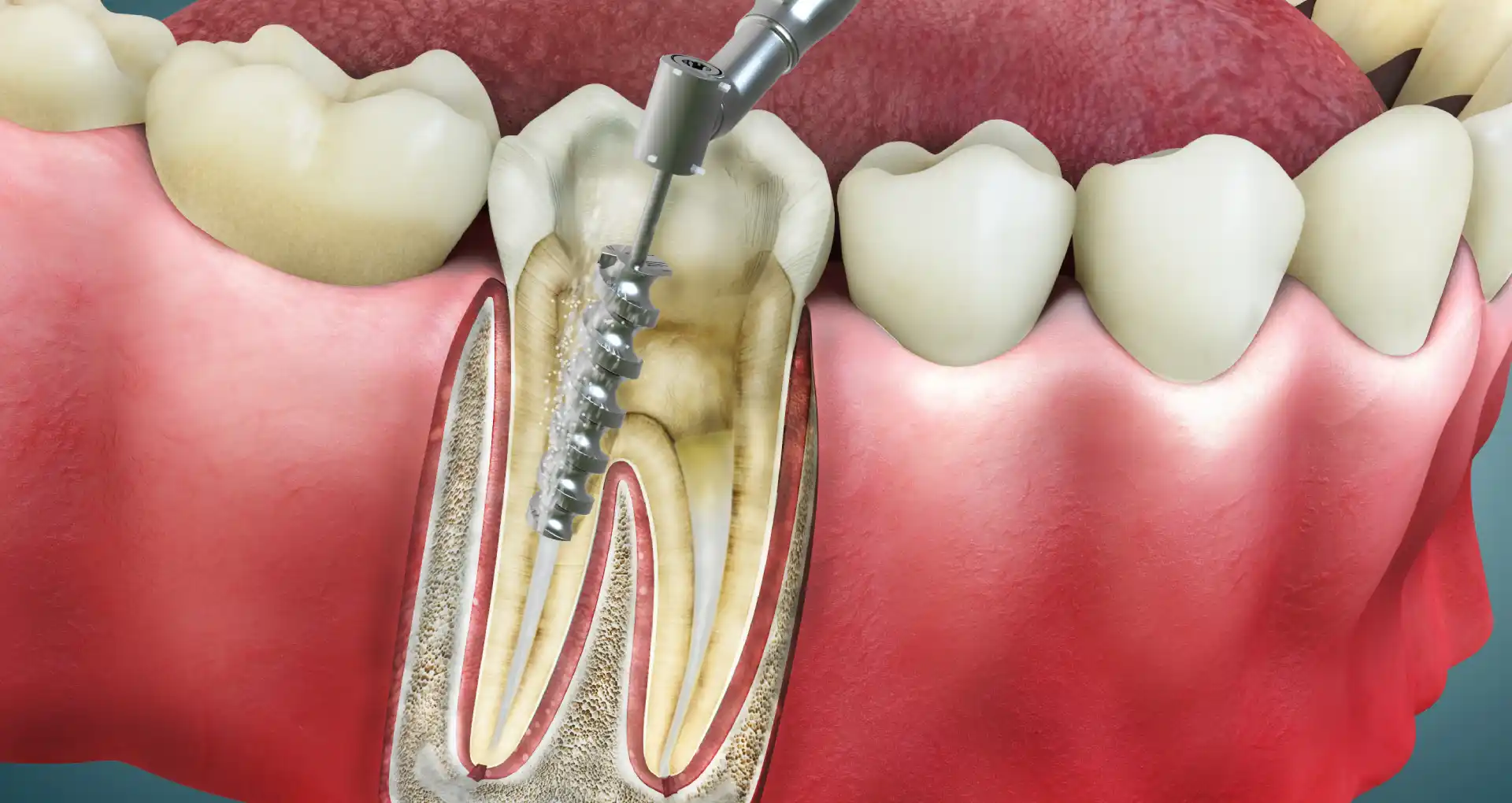 Root canal treatment illustration showing removal of infected pulp and cleaning of tooth canal