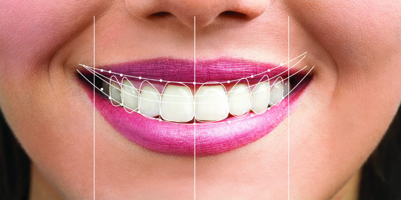 Digital smile designing treatment for perfect smile makeover in Indore
