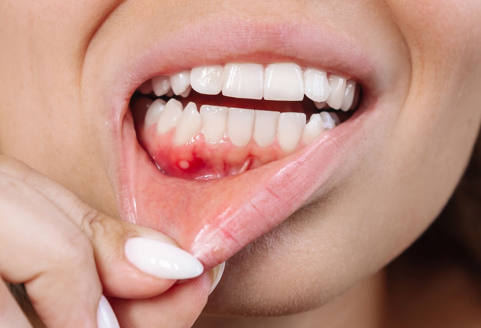 Early signs of oral cancer showing mouth ulcer and gum lesion