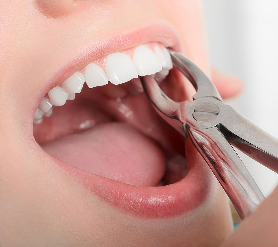 Tooth extraction procedure under general dentistry treatment in Indore