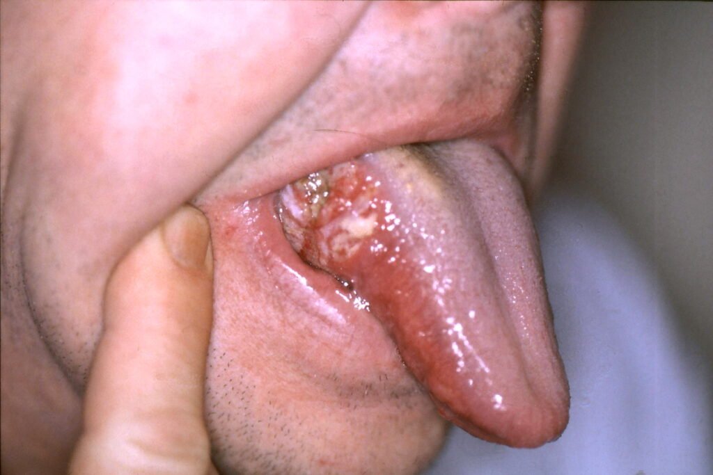 Tongue ulcer and lesion showing possible signs of oral cancer