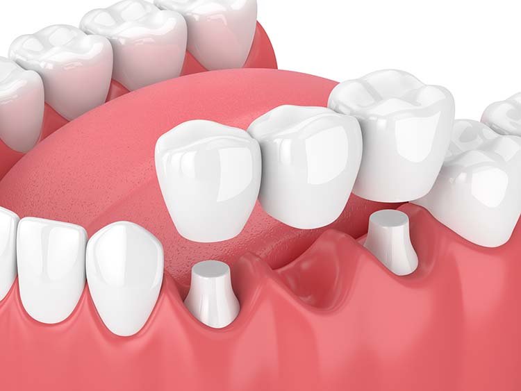 Dental bridge treatment for missing teeth replacement by dentist in Indore