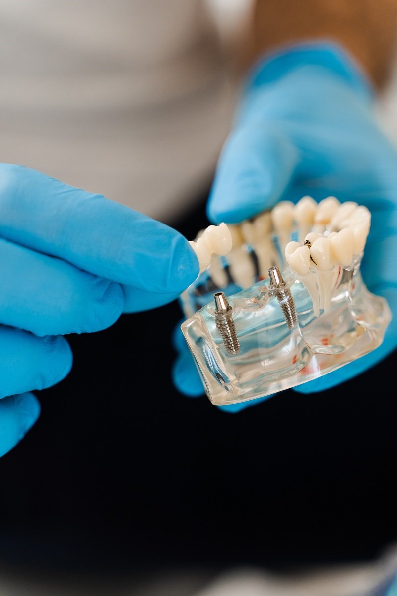 Dentist holding dental implant model with artificial teeth and titanium screws