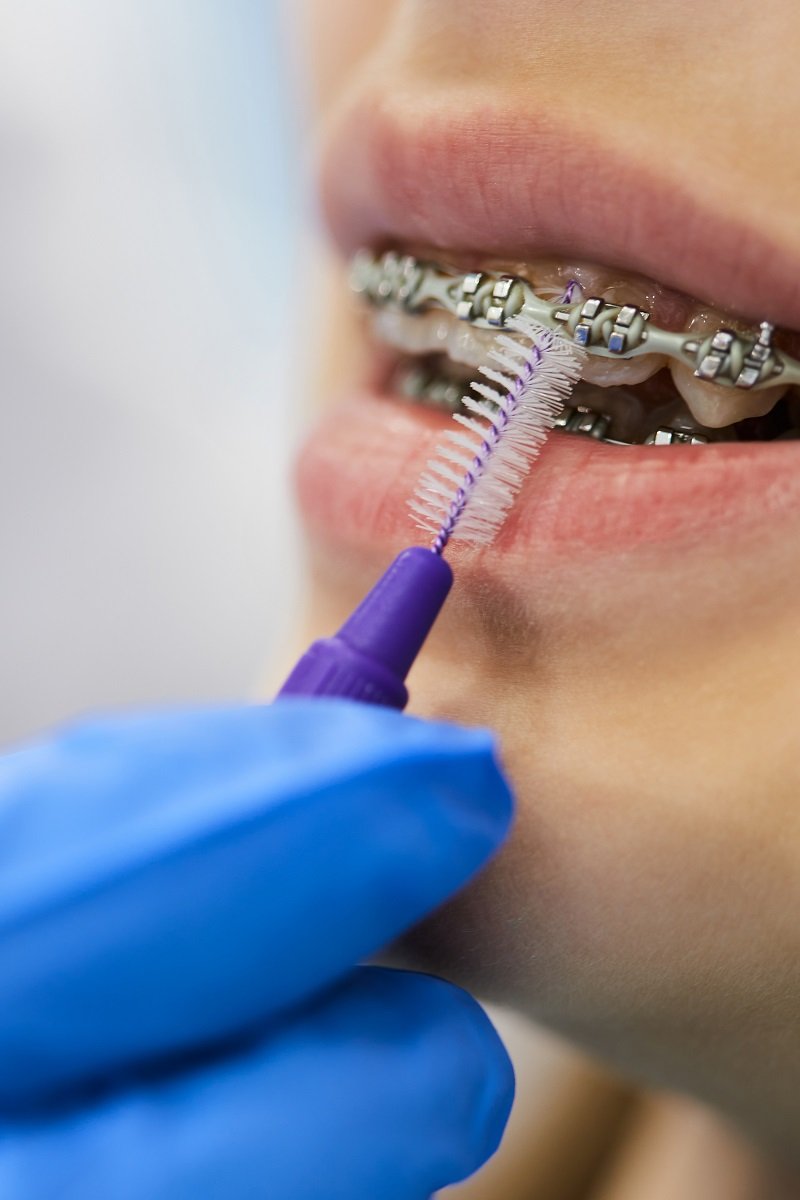 Interdental brush cleaning teeth with braces for better oral hygiene