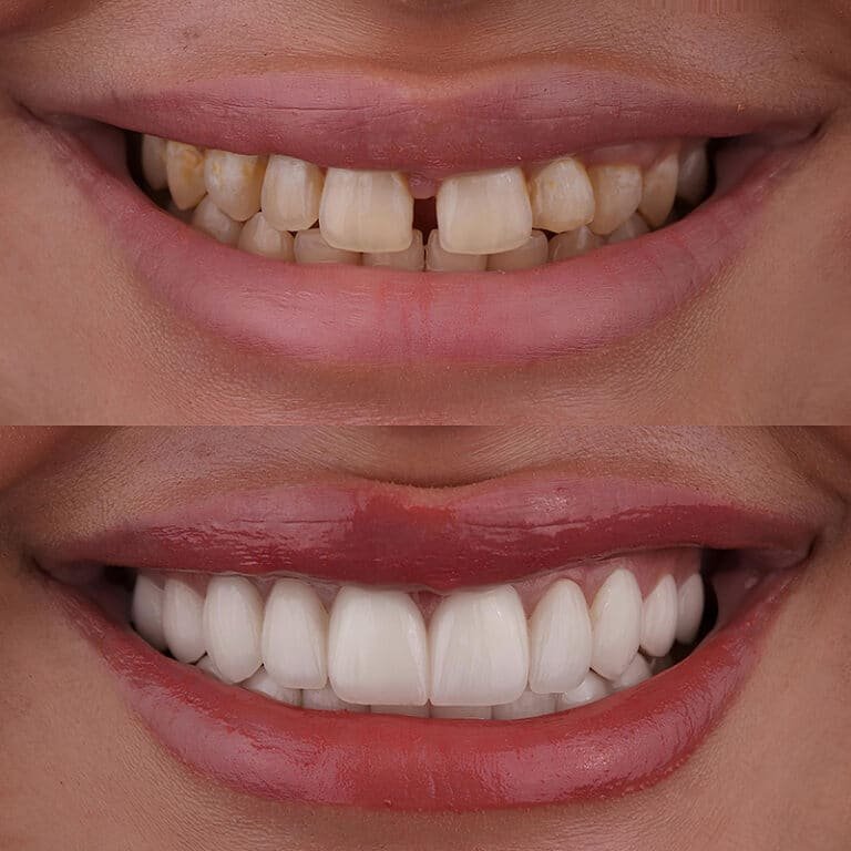 Before and after cosmetic dentistry smile makeover and teeth whitening in Indore