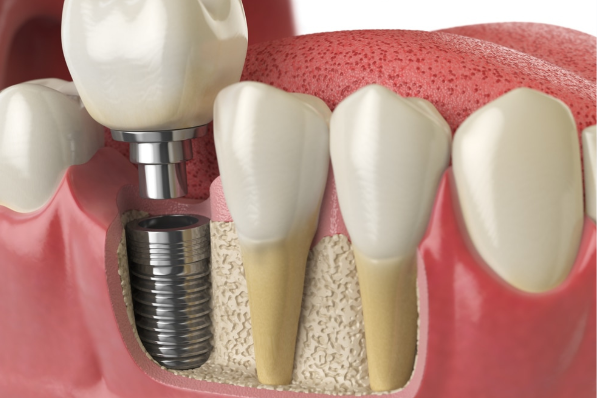 Dental implant procedure illustration showing titanium implant placement in jawbone for missing tooth replacement