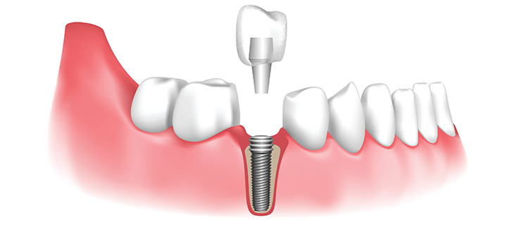 Dental implant procedure illustration showing tooth replacement and implant placement in Indore
