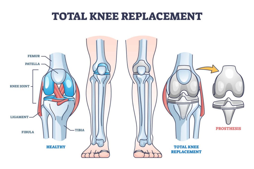 Total knee replacement diagram showing healthy knee joint and artificial knee implant prosthesis