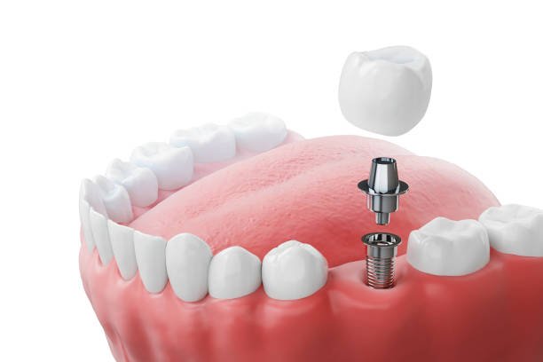 Dental implant placement process showing artificial tooth and implant structure in Indore