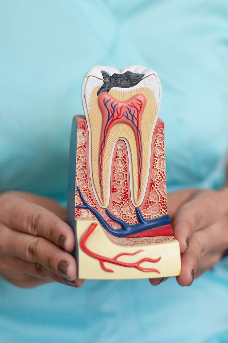 3D dental tooth model showing cavity and inner tooth structure