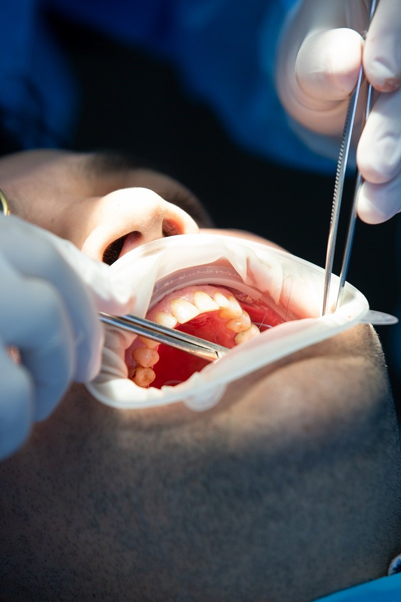 Dentist performing dental treatment using instruments inside patient’s mouth