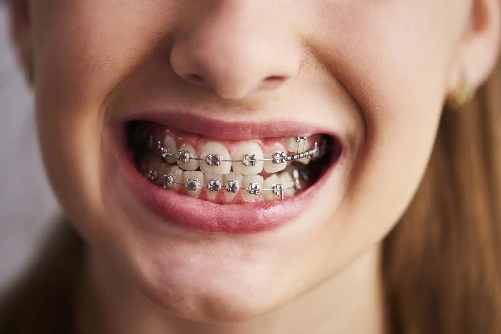 Metal braces treatment for teeth alignment and smile correction in Indore