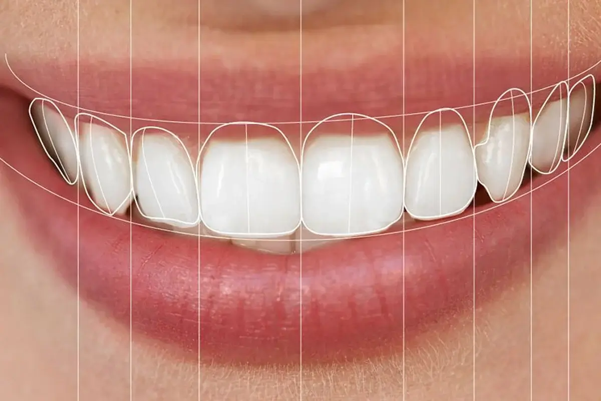 Digital smile designing treatment for perfect smile makeover in Indore