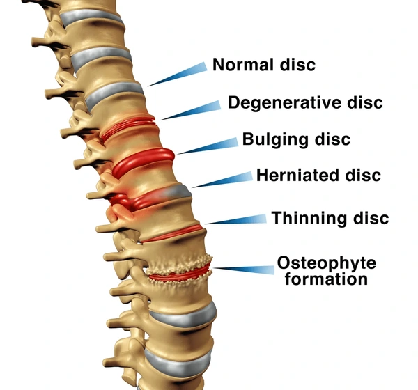 Spine diagram showing normal disc, bulging disc, herniated disc and slip disc stages