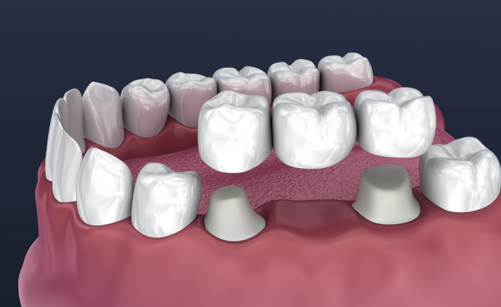 Dental crown and bridge treatment for missing teeth restoration in Indore