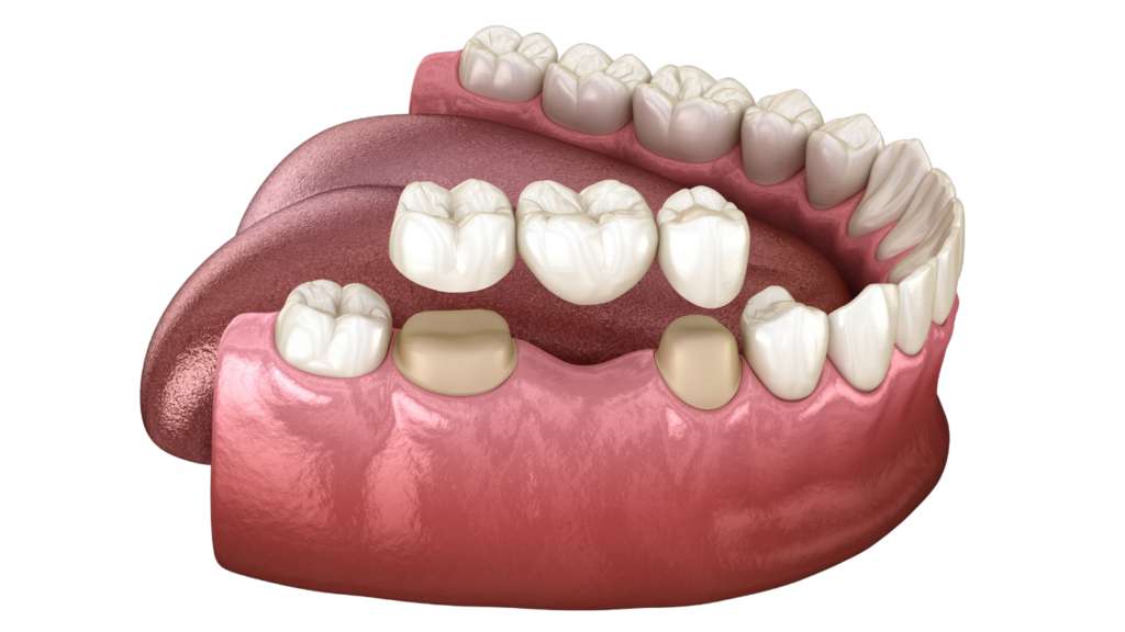 Dental crown and bridge treatment for missing teeth restoration in Indore
