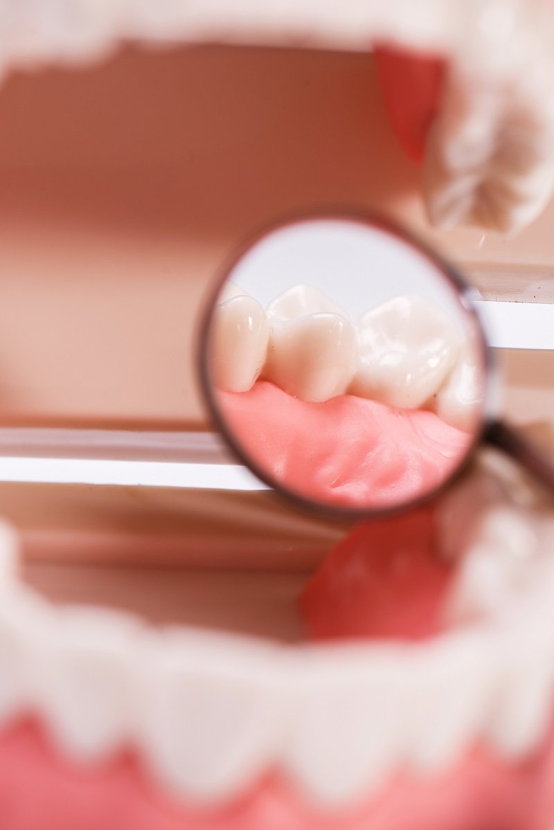 Close-up view of teeth and gums examined with a dental mirror during oral checkup