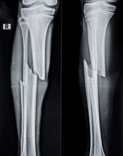 X-ray showing leg bone fracture treated under accidental and fracture orthopedic surgery
