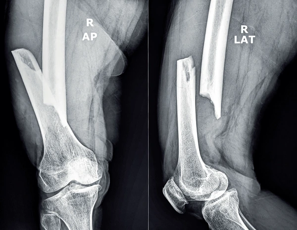 X-ray of elbow fracture showing broken bone treated with accidental and fracture orthopedic surgery