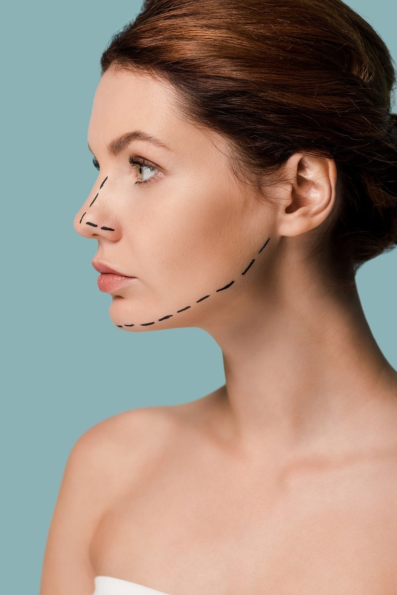 Woman with facial markings for cosmetic plastic surgery consultation