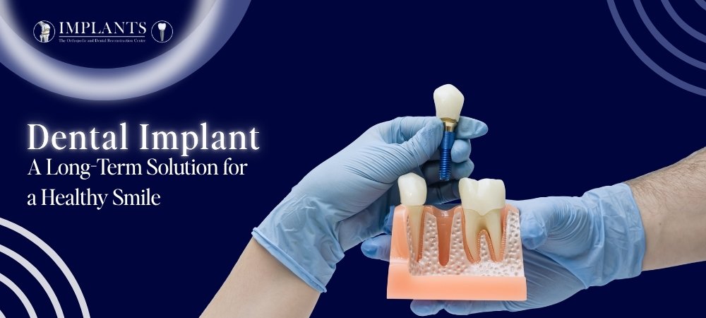Dental Implant Treatment in Indore, A Long-Term Solution for a Healthy Smile